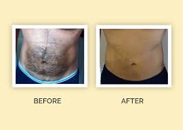 If it does appear, it people like how this hair removal method works on the face and in awkward places. Hair Removal Archives Skinarts Aesthetics