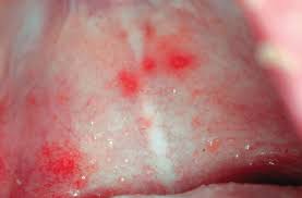 Image result for Physical injury red spots roof of mouth