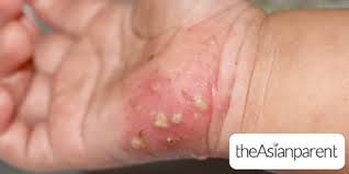 Image result for scabies symptoms