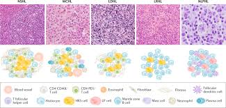 Hodgkin Lymphoma Nature Reviews Disease Primers