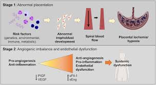 Image result for Mild PIH Management