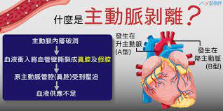 比起因為馬凡氏症導致的主動脈剝離， 因為高血壓或其他因素的病例是馬凡的上百倍吧。 最後想說的是真的被診斷有馬凡也不用太擔心， 因為馬凡氏症的表徵其實很多元， 從真的最嚴重的重症到一生完全無症狀都有。 è‡´æ­»çŽ‡è¶…éŽä¹æˆ æ­£ç¢ºé¢å°ä¸»å‹•è„ˆå‰é›¢ é†«è¯ç¶²