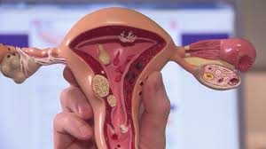 Ein myom (gebärmuttergeschwulst) ist ein gutartiger, hormonsensibler tumor der muskelschicht der gebärmutter. Myome In Der Gebarmutter Behandlungsoptionen Youtube