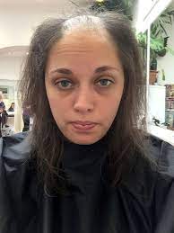 Di samping itu, kekurangan vitamin juga boleh menjadi satu punca dan folikel rambut lemah. Punca Rambut Gugur Di Usia Muda Vitamin Ummi Zara Pakar Kesihatan Anda