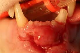 How do you treat a busted lip that is very swollen? Injury To Cat Lip Feline Lip Avulsion Vet Dentistry Dale Kressin Dvm Davdc Of Animal Dentistry And Oral Surgery Specialists Llc