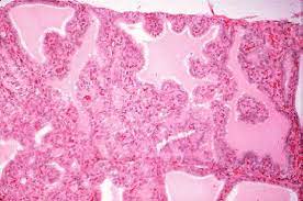 Sign out history provided total thyroid, total thyroidectomy: Graves Disease And The Manifestations Of Thyrotoxicosis Endotext Ncbi Bookshelf