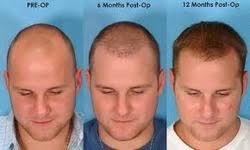 Manufacturer Of No Bald Hair Regrowth Oil Nobald Hair Regrowth Oil By No Bald Hair Regrowth Oil Coimbatore