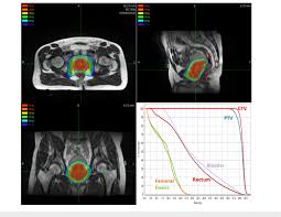 And you&#x27;ve got absolutely nothing to worry about. Prostate Stereotactic Body Radiotherapy Treatment Plan Dose Download Scientific Diagram