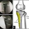 • medial meniscus forms receptacle for medial femoral condyle, lateral meniscus receives lateral femoral condyle. Https Encrypted Tbn0 Gstatic Com Images Q Tbn And9gcswcofqlne45ywfbuzpd3oeex87ijsr4frytpmoz31tck B2e2n Usqp Cau