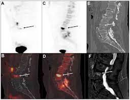 The features are those of metastatic … 68ga Psma Pet Ct For The Detection Of Bone Metastasis In Recurrent Prostate Cancer And A Psa Level 2 Ng Ml Two Case Reports And A Literature Review