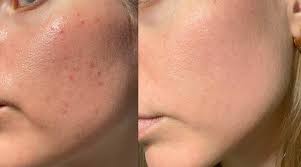 Dry Skin vs Combination Skin: How to Identify the Difference