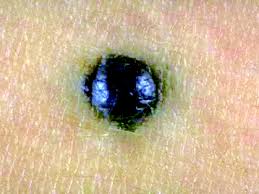 Image result for Blue Nevus