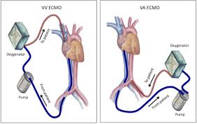 Patient selection criteria, cannulation and decannulation strategies, transport. Extracorporeal Membrane Oxygenation During Adult Noncardiac Surgery And Perioperative Emergencies A Narrative Review Journal Of Cardiothoracic And Vascular Anesthesia