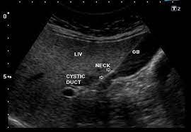 Batu empedu yang terbentuk dari kolesterol, campuran, pigmen gambar blm jadi. Biliary Ultrasound Docnesia Com