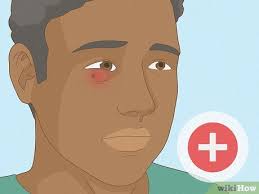 How to Remove a Thorn: 14 Steps (with Pictures)