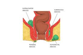 Image result for Perirectal Abscess