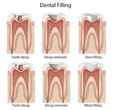 Sorry that this probably not what you wanted to hear. Dental Filling Procedure