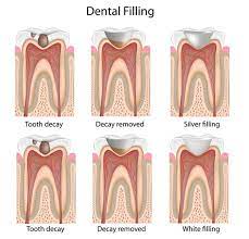 So, you have to send these forms (w7. Dental Filling Procedure