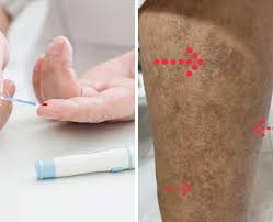 Makanan yang baik untuk penderita asam urat adalah yang rendah purin. Bertahun Tahun Hidap Kencing Manis Jangan Sampai Kaki Bertompok Itu Petanda Serius Dr Ni Dedahkan Agar Ramai Faham Keluarga