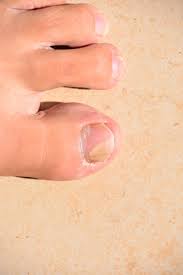 You can get it from stubbing a when toenails turn yellow, a fungus is usually to blame. Staying One Step Ahead Of Toenail Fungus Harvard Health