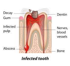 Why Root Canal Treatment For Broken Teeth Might Be Necessary Irvine Root Canal Specialist