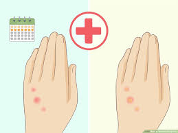 Most mosquito bite relievers are topical creams, ointments, gels, or liquids you apply directly to the bite to counteract the histamines. How To Treat Bed Bug Bites 12 Steps With Pictures Wikihow