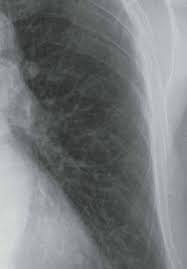 The decrease in other more severe symptoms is wheezing which if. Clinical Manifestations Of Sarcoidosis Intechopen
