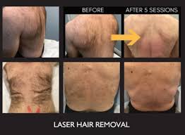 This is a video talking to you guys about my laser hair removal journey at ideal image. Laser Hair Removal Flemington Permanent Hair Reduction Princeton