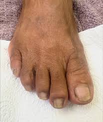 Image result for toe black diabetes