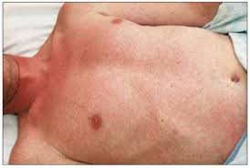 Image result for skin rash acute hiv infection