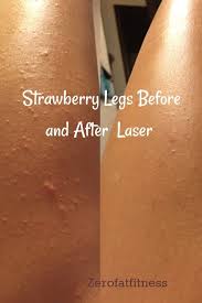 Strawberry Legs Before And After Laser Strawberry Legs Exfoliate Legs Apple Cider Vinegar For Hair