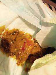 Does This Look Like Blood In Lo S Stool Tmi Pic Babycenter