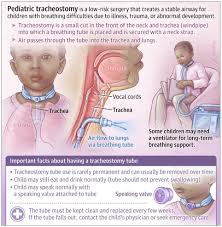 Image result for Tracheostomy