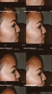 Agéndate, elige ser tu mejor versión!  #nopaguesmas#rinoplastia#huila#neiva#cirugia#ultrasonica