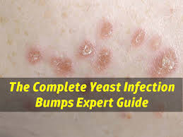 Yeast Infection Bumps Are Your Skin Bumps Caused By Yeast Infection Yeast Infection On Skin Yeast Infection Yeast Infection Causes