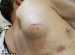 Start by asking your doctor, says dr. Man 66 Grows A Bubble Under The Skin When Air Escaped From His Cancerous Lung Daily Mail Online