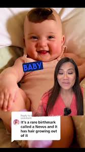 A type of nevus (mole) called a congenital pigmented hairy nevus ❤️  #drpimplepopper #nevus @life_of_a_binge_eater_