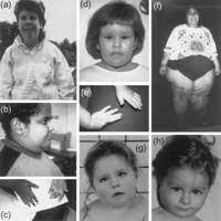 Prader Willi Syndrome Causes Symptoms Treatment Schoolworkhelper