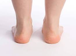 Des semelles orthopédiques contre les maladies du pied. Semelles Orthopediques Pour Le Mal De Dos Essentielles Ou Optionnelles