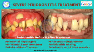 With no bad bacterias living onto the gentle gum tissues and feeding on these soft tissues to and the gum tissue will start recovery. Periodontitis Gingivitis Meaning Symptoms Tx Gum Disease