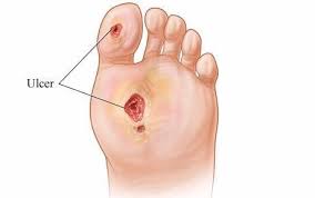 Image result for diabetic toes