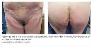 Image result for sore skin in the groin area