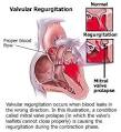 Bleeding heart valve