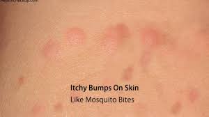 It's dry skin and don't scratch them because it makes them worst. Itchy Bumps On Skin Like Mosquito Bites Causes Treatment Prevention