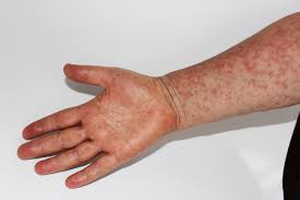 Image result for measles