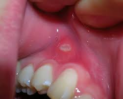 However, this only treats the surface of the situation. Gum Injuries Children S Dentistry Of Longwood P A