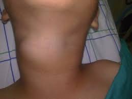 Traitement chirurgical du kyste pilonidal. Kyste Hydatique De La Thyroide Chez L Enfant Sciencedirect