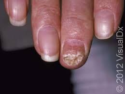 Image result for onychomycosis