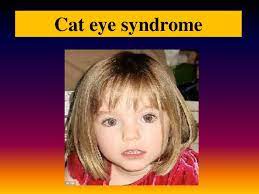 Trisomy 22 Cat Eye Syndrome Google Search Cat Eye Syndrome Eyes Pediatrics