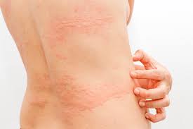 Skin Rashes Facts Types Causes Complications